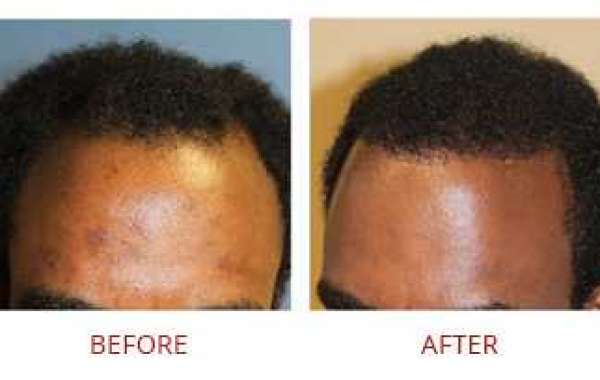 Que es la restauración de cabello texturizado
