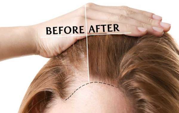 Why London Leads the World in Hair Restoration Innovation